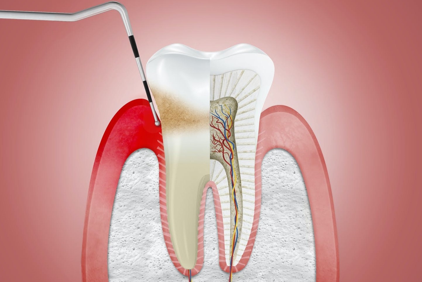 Gingivitis y Periodontitis