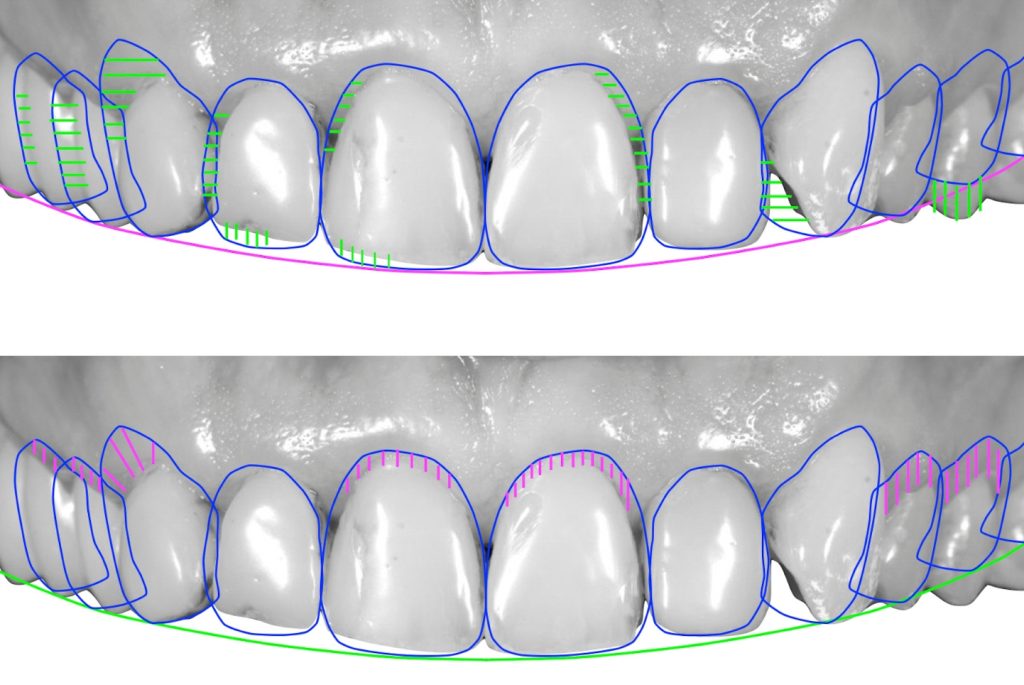 diseño de sonrisa digital